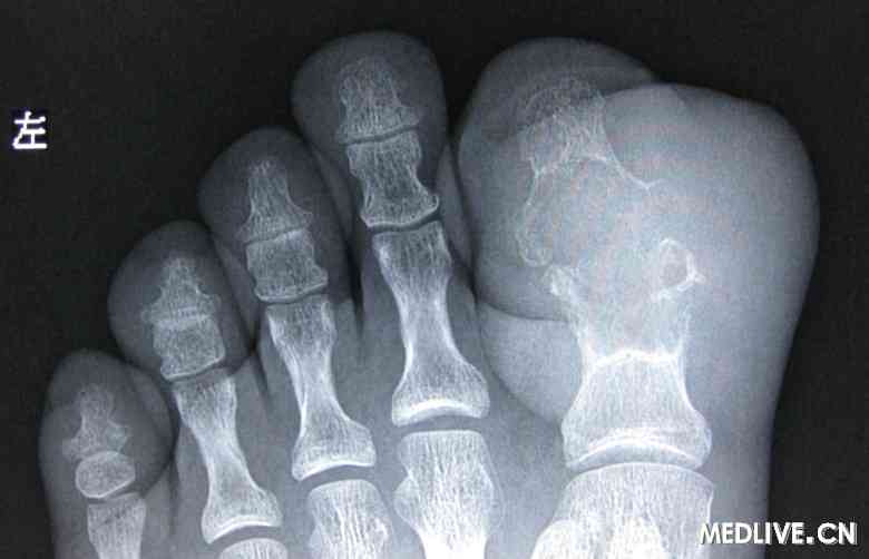 男,45岁,左踇趾跖趾关节疼痛伴肿块形成并破溃