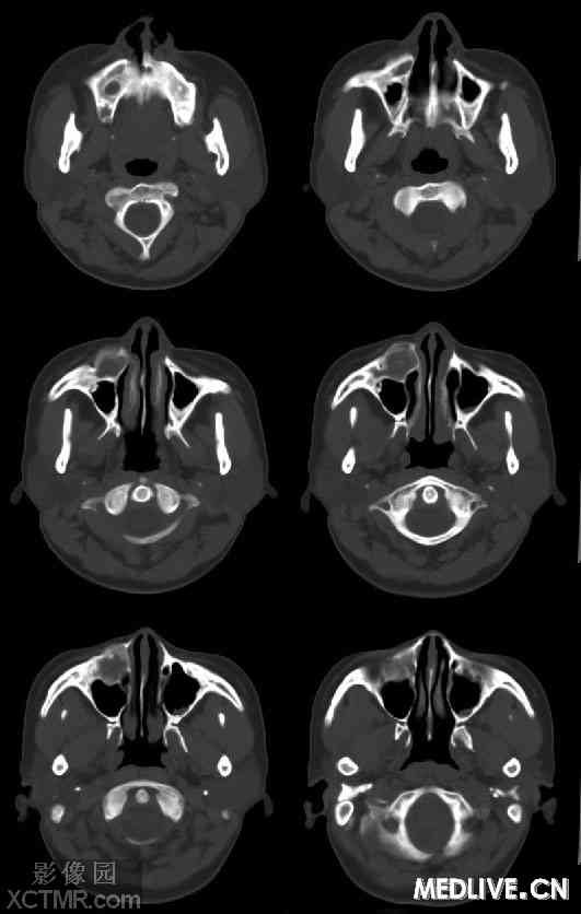 右侧上颌骨骨化性纤维瘤maxillaryossifyingfibromact病例图片影像