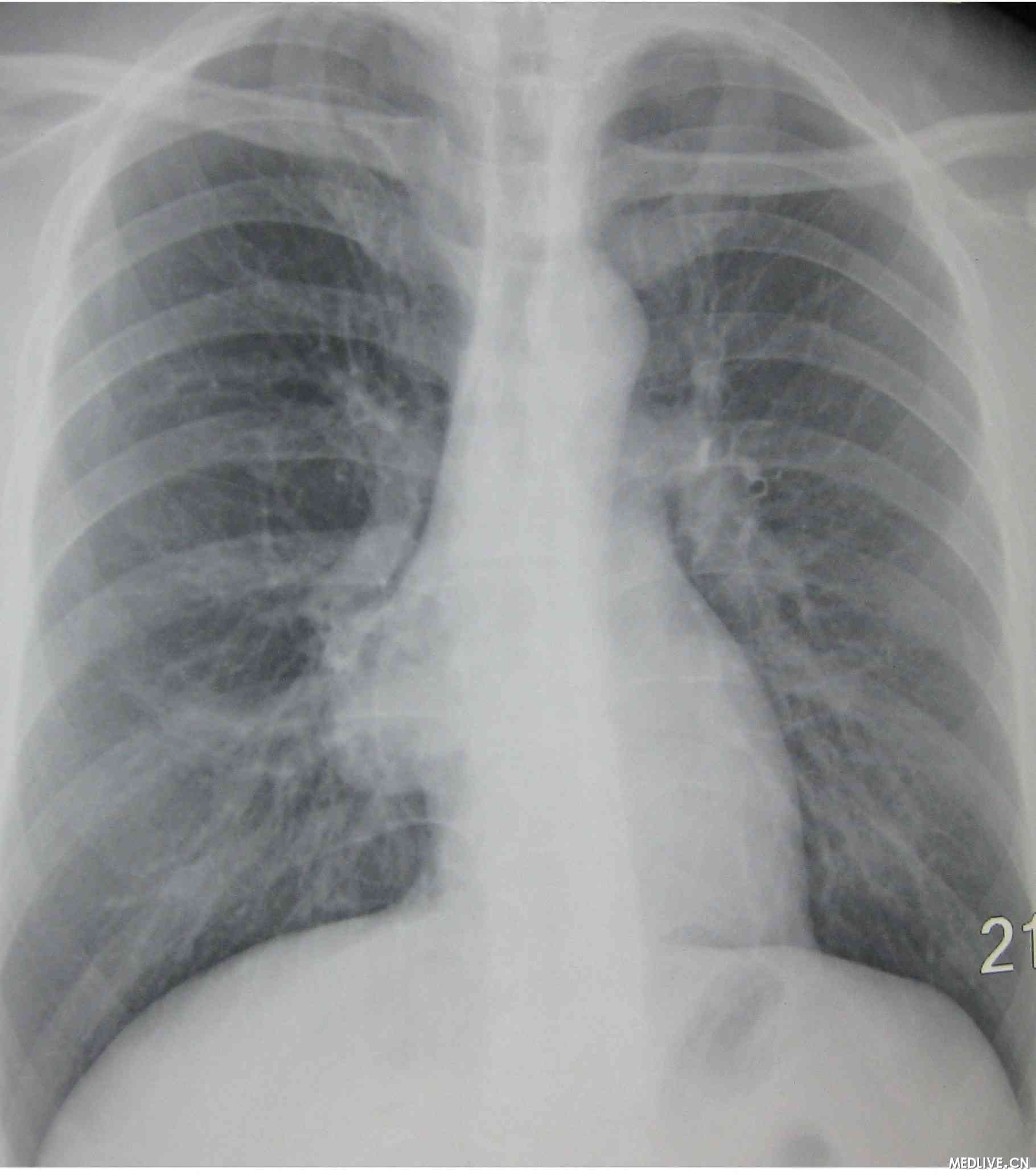 病例41：纵膈气肿（胸片+CT） - 医学影像学讨论版 - 爱爱医医学论坛