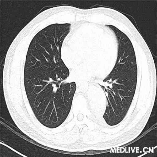肺窗示图片