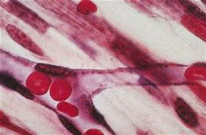 鱼雷斑病：一种主要的脉络膜毛细血管异常