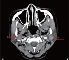双侧腮腺同时发生不同病理类型的良性肿瘤1例