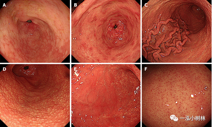 急性肠胃炎胃镜图片图片